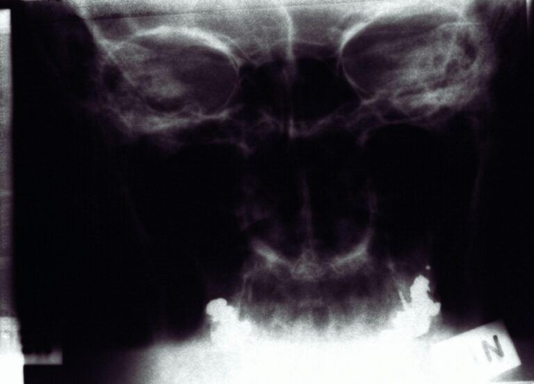 Wanneer ego pijn doet: De diagnose van NPD begrijpen